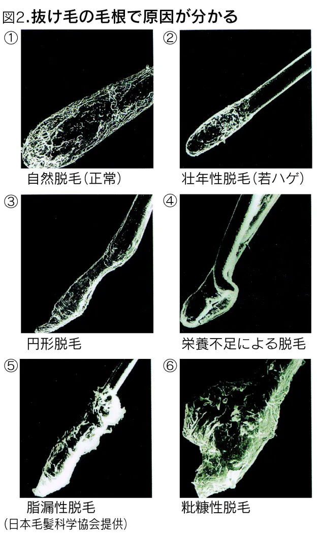 脱毛の種類を判別するには 薄毛はどの国に多い 世界毛髪マップ Nikkei Style 脱毛の種類を判別するには 薄毛はどの国に多い 世界毛髪マップ Nikkei Style