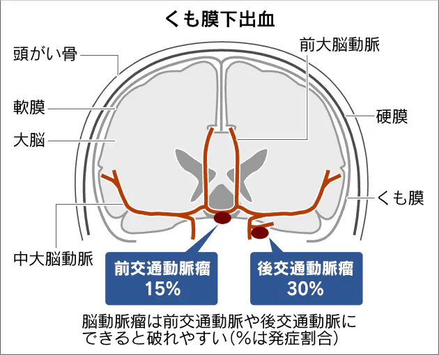 健康 でも発症 くも膜下出血 たばこ 高血圧が危険因子 Nikkei Style