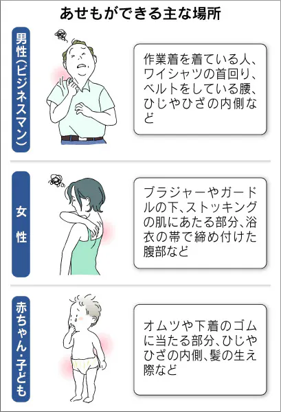 節電あせも 急増中 対処法は Nikkei Style