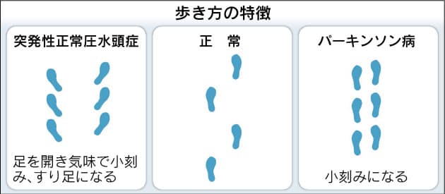 高齢者の水頭症 髄液抜いて改善 Nikkei Style 高齢者の水頭症 髄液抜いて改善 Nikkei Style