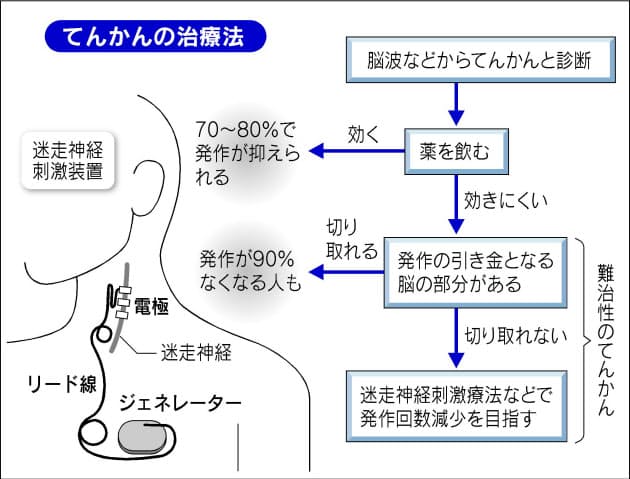 てんかん発作 薬で7 8割抑制 意識失いけいれん は一症状 Nikkei Style