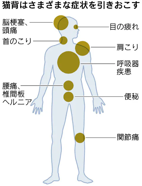 侮れない猫背 意外な万病のもと 肩こり 腰痛 Nikkei Style