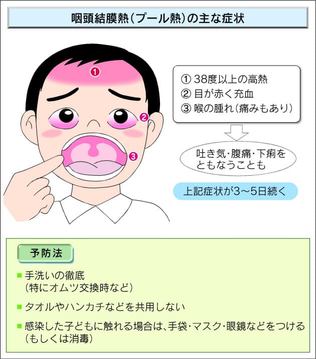 夏こそご用心 プール熱 意外に広い感染経路 Nikkei Style