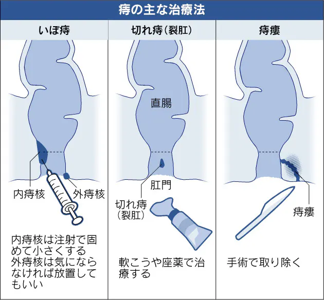 冬は痔の大敵 苦しまないための予防と治療法 Nikkei Style