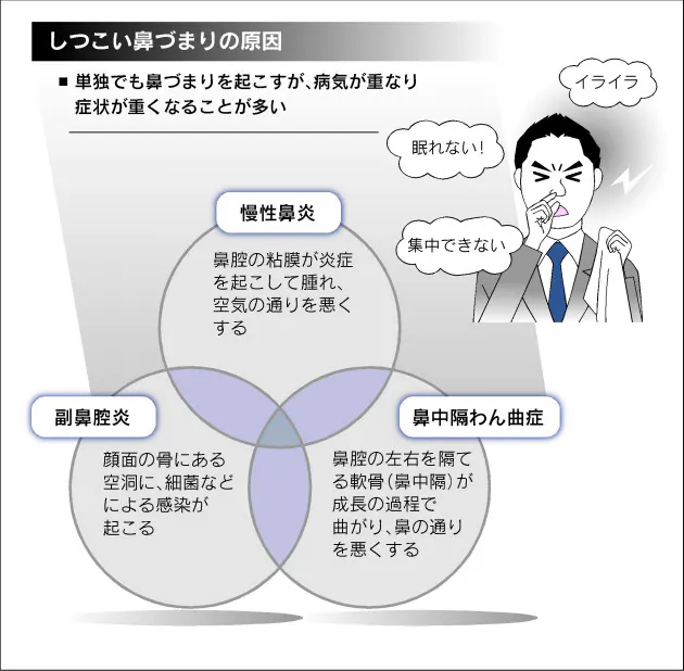 こまめに掃除 しつこい鼻づまりご用心 複数の病気が潜むことも Nikkei Style