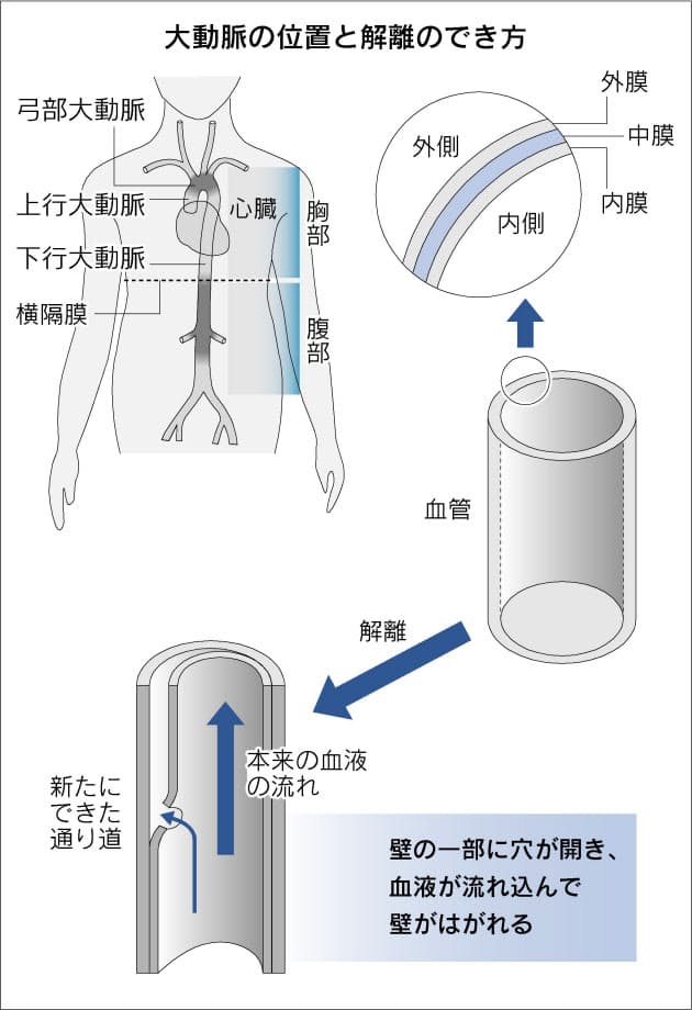血管が裂ける大動脈解離 高血圧に忍び寄る危険 Nikkei Style