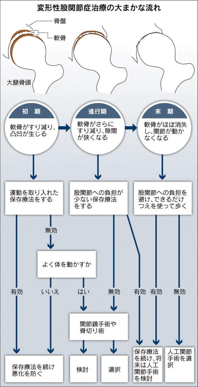 股関節 痛っ まず減量を 中年女性は特にご用心 Nikkei Style 股関節 痛っ まず減量を 中年女性は特にご用心 Nikkei Style