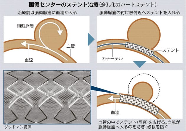 立体画像撮影 脳動脈瘤の破裂 新技術で防ぐ Nikkei Style