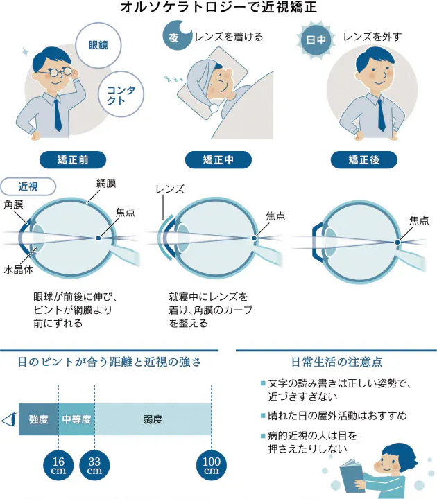 眼鏡っ子に朗報 就寝中にコンタクトすれば近視改善 Nikkei Style