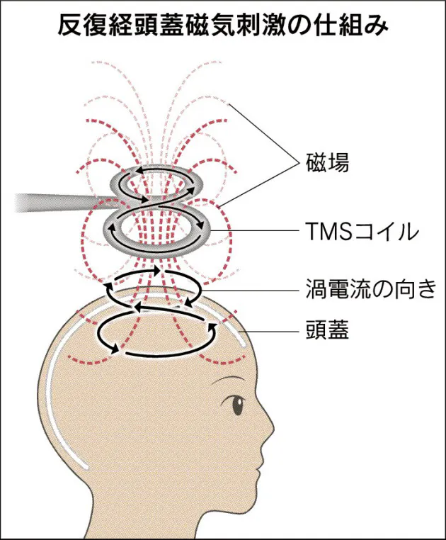 Rtms療法 米では08年に認可 電気けいれんと補完的効果も うつ病を磁気刺激で治す Nikkei Style