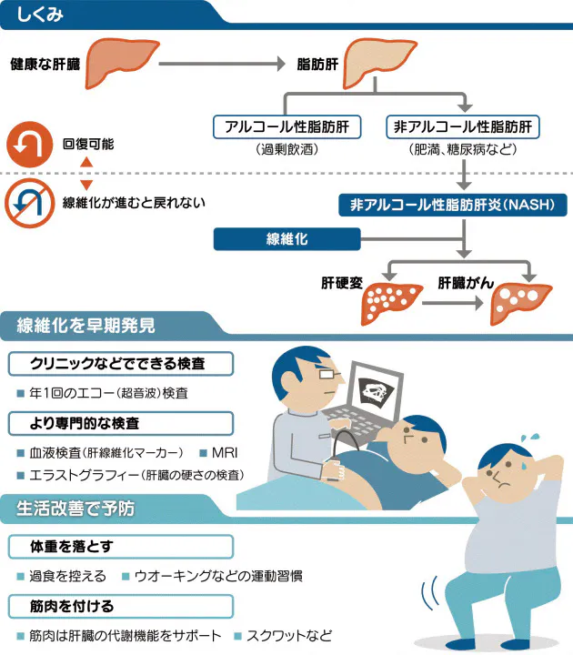 放っておくと肝臓がん 怖い脂肪肝 飲酒以外にも原因 Nikkei Style