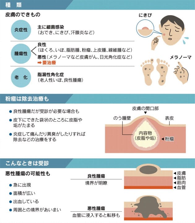 皮膚の できもの 正しく対処 痛みだけで判断しない Nikkei Style 皮膚の できもの 正しく対処 痛みだけで判断しない Nikkei Style