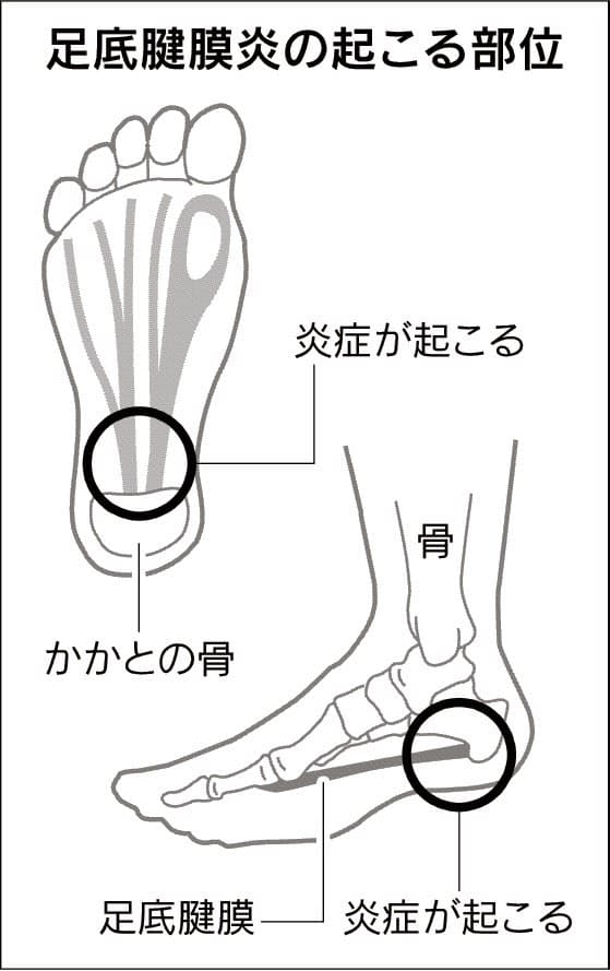 足の裏に痛み 足底腱膜炎 足休めて衝撃波で治療も Nikkei Style 足の裏に痛み 足底腱膜炎 足休めて衝撃波で治療も Nikkei Style