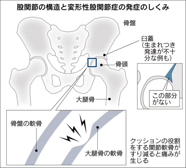 歩き方変わった 変形性股関節症の疑い 手術で改善 Nikkei Style