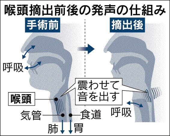 失った声再建 励まし合って 声帯摘出2 3万人 Nikkei Style 失った声再建 励まし合って 声帯摘出2 3万人 Nikkei Style