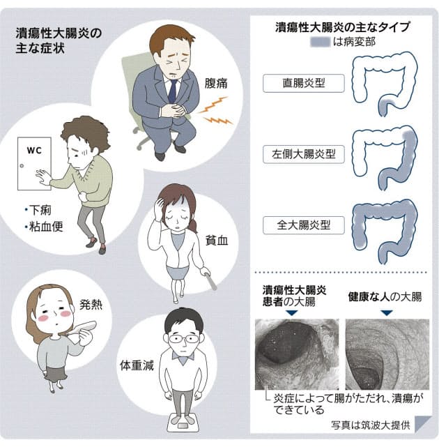 増える潰瘍性大腸炎 下痢や血便繰り返す難病 Nikkei Style