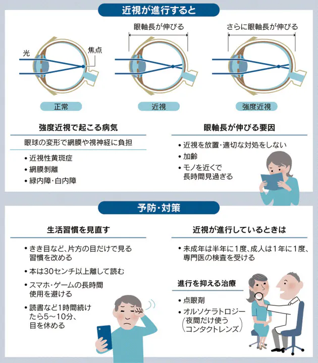 近視は放置ng 失明リスクも スマホ酷使には注意 Nikkei Style