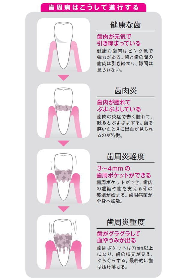 女性の大敵 歯周病 早産や動脈硬化のリスクに Nikkei Style 女性の大敵 歯周病 早産や動脈硬化のリスクに Nikkei Style