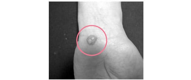 水虫 手足の皮むけ 水ぶくれは 汗づまり かも Nikkei Style 水虫 手足の皮むけ 水ぶくれは 汗づまり かも Nikkei Style