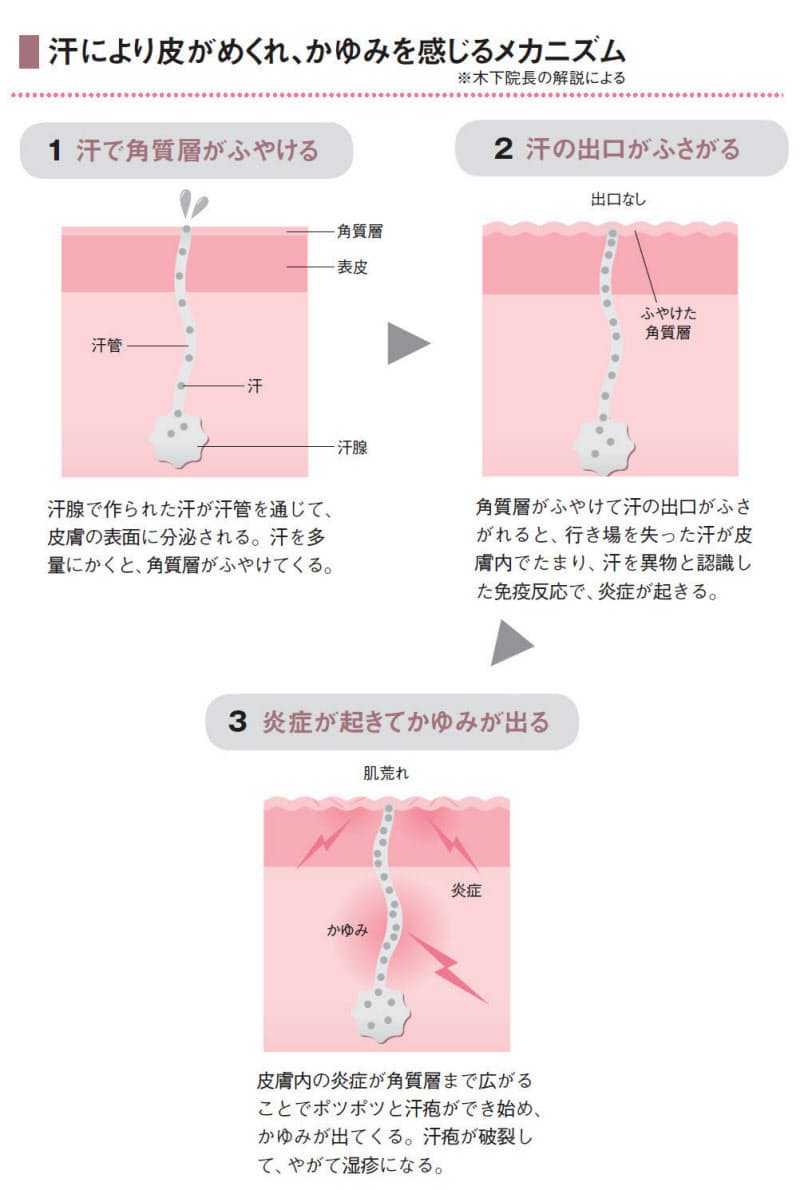 水虫 手足の皮むけ 水ぶくれは 汗づまり かも Nikkei Style 水虫 手足の皮むけ 水ぶくれは 汗づまり かも Nikkei Style