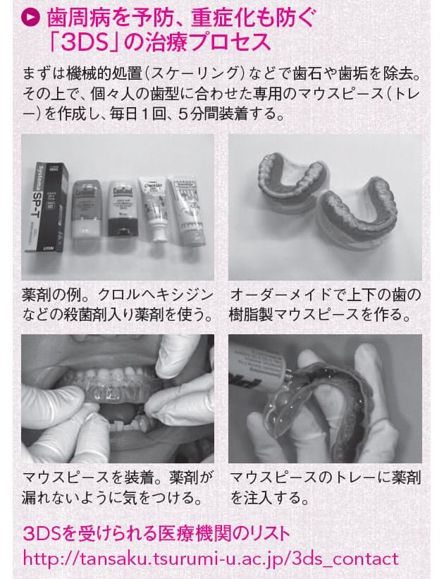歯周病に新治療 3ds 専用マウスピースを1日5分 Nikkei Style