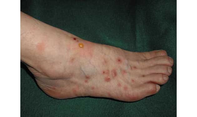 蚊 ネコノミ ヒアリ 虫に刺されたらどう対処 Nikkei Style