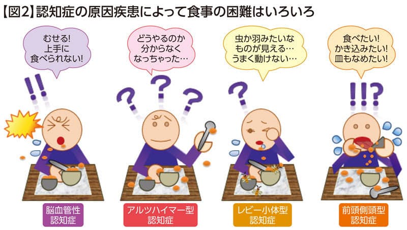 知れば慌てない 認知症の種類で異なる 食事の困難 Nikkei Style 知れば慌てない 認知症の種類で異なる 食事の困難 Nikkei Style