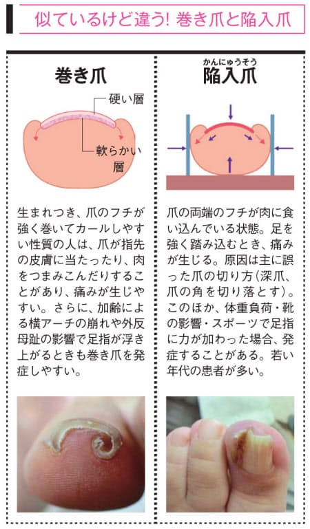 巻き爪 食い込んだ爪 カールしないよう爪を広げる Nikkei Style 巻き爪 食い込んだ爪 カールしないよう爪を広げる Nikkei Style