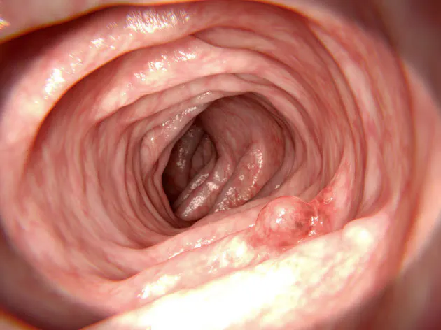 進行していない腺腫 の大腸がん発症率は 腺腫なし と同程度 進行していないポ Nikkei Style