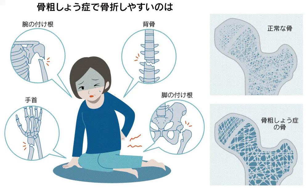 かかと落としで骨粗しょう症防ぐ カルシウムも補給を Nikkei Style