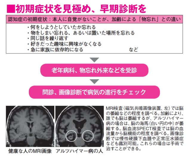 早期発見による薬物治療でアルツハイマー病の進行を抑制 Nikkei Style 早期発見による薬物治療でアルツハイマー病の進行を抑制 Nikkei Style