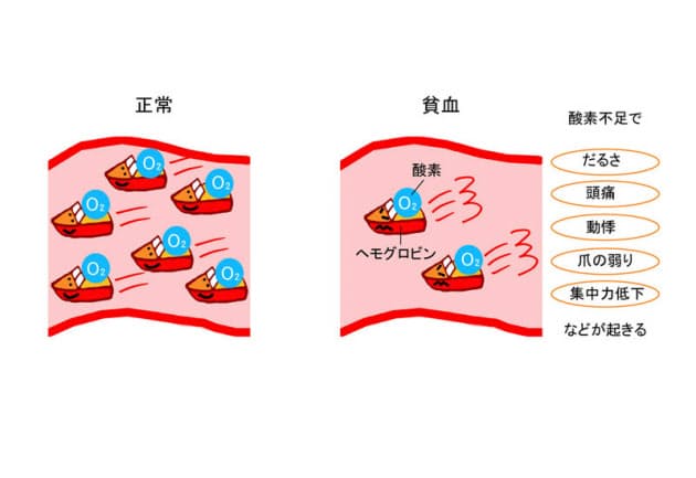 妊活女子は隠れ貧血注意 健診で4割以上 早産リスク Nikkei Style 妊活女子は隠れ貧血注意 健診で4割以上 早産リスク Nikkei Style