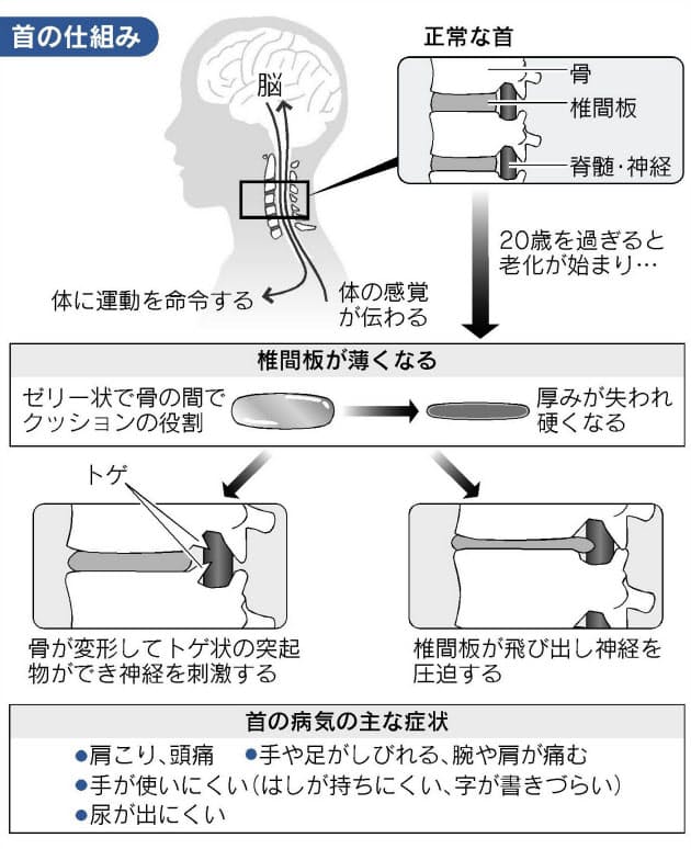 日本人の4分の3が経験 首の痛み 原因と予防策 放置すると下半身や手の指にも影響 Nikkei Style 日本人の4分の3が経験 首の痛み 原因と予防策 放置すると下半身や手の指にも影響 Nikkei Style