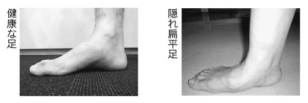 増える 隠れ扁平足 筋トレや中敷きの見直しで改善 Nikkei Style 増える 隠れ扁平足 筋トレや中敷きの見直しで改善 Nikkei Style
