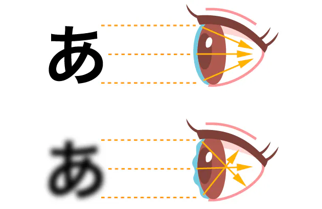 ソフトコンタクトで痛みに気づきにくいことも ドライアイがうつリスク招く 角膜 Nikkei Style
