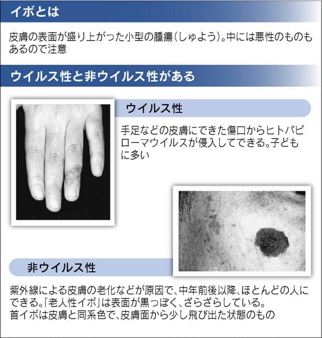 気になるイボ 種類によって異なる予防法と対処法 Nikkei Style 気になるイボ 種類によって異なる予防法と対処法 Nikkei Style