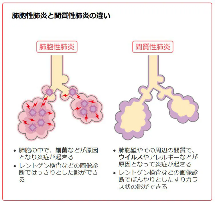 ウイルス性肺炎はそもそも診断が難しい 新型コロナによる肺炎 通常の肺炎と何が違 Nikkei Style