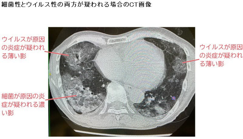 ウイルス性肺炎はそもそも診断が難しい 新型コロナによる肺炎 通常の肺炎と何が違 Nikkei Style ウイルス性肺炎はそもそも診断が難しい 新型コロナによる肺炎 通常の肺炎と何が違 Nikkei Style