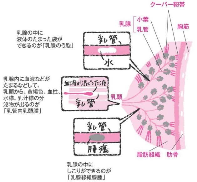 大きくなって痛みが強ければ細胞診を 乳がんだけじゃない バストのトラブルと見つ Nikkei Style