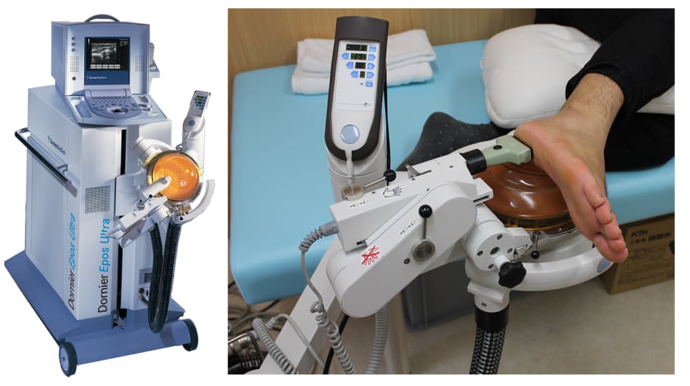 足底腱膜炎 に新治療 体外衝撃波で痛みを取る Nikkei Style