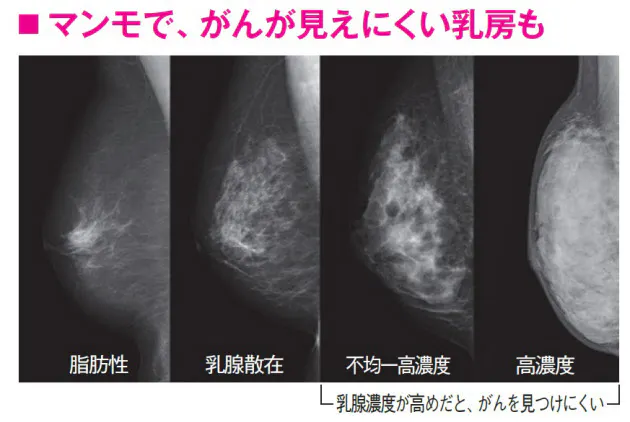 マンモグラフィ検診で発見が難しい乳がんを知って Nikkei Style
