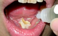 スギ花粉のエキス液を口にふくむ舌下免疫療法（東京・文京区の日本医科大病院）