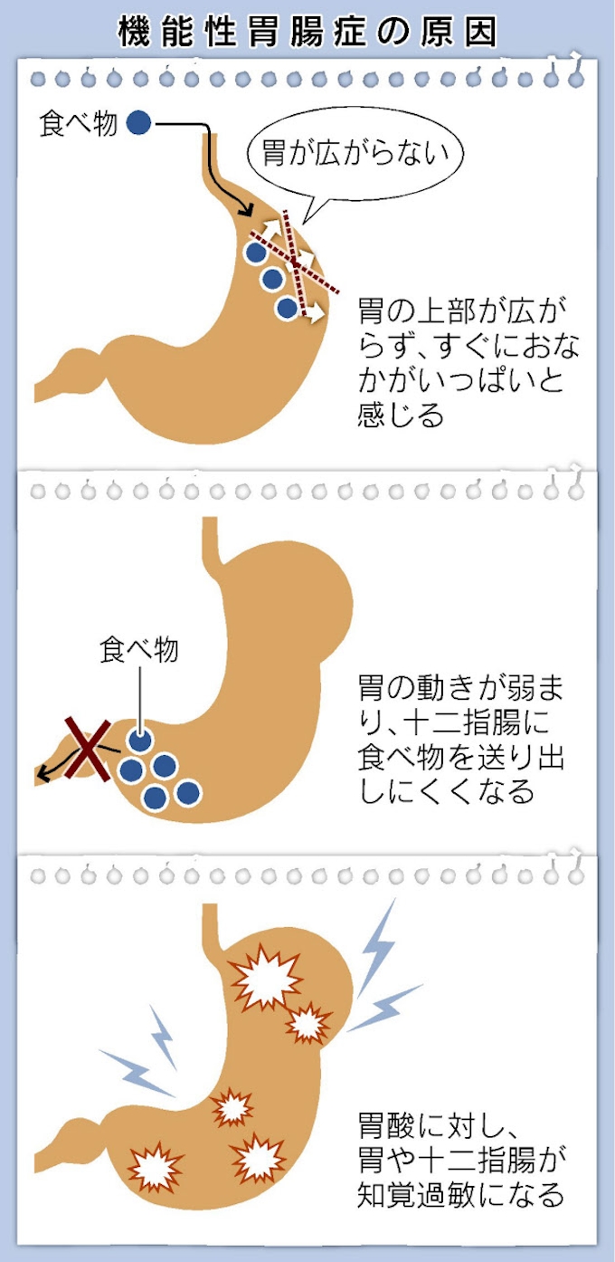 胃もたれ 痛み 粘膜に異常なし 機能性胃腸症の疑い 日本経済新聞