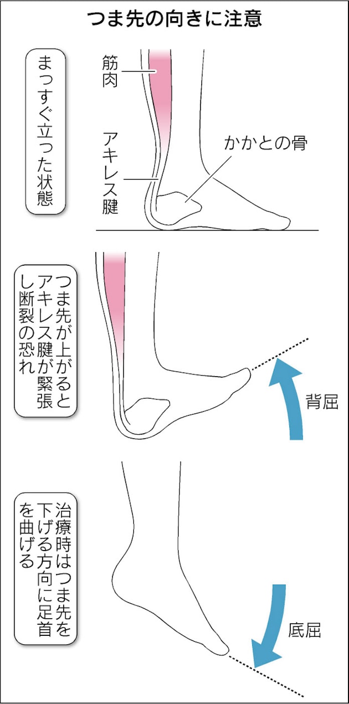 アキレス腱断裂 治療は根気よく 日本経済新聞 アキレス腱断裂 治療は根気よく 日本経済新聞