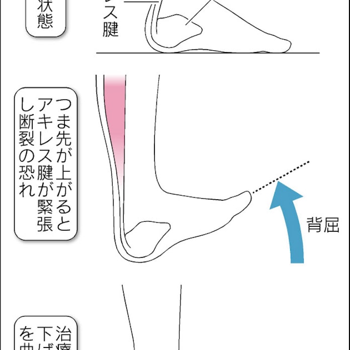 アキレス腱断裂 治療は根気よく 日本経済新聞 アキレス腱断裂 治療は根気よく 日本経済新聞