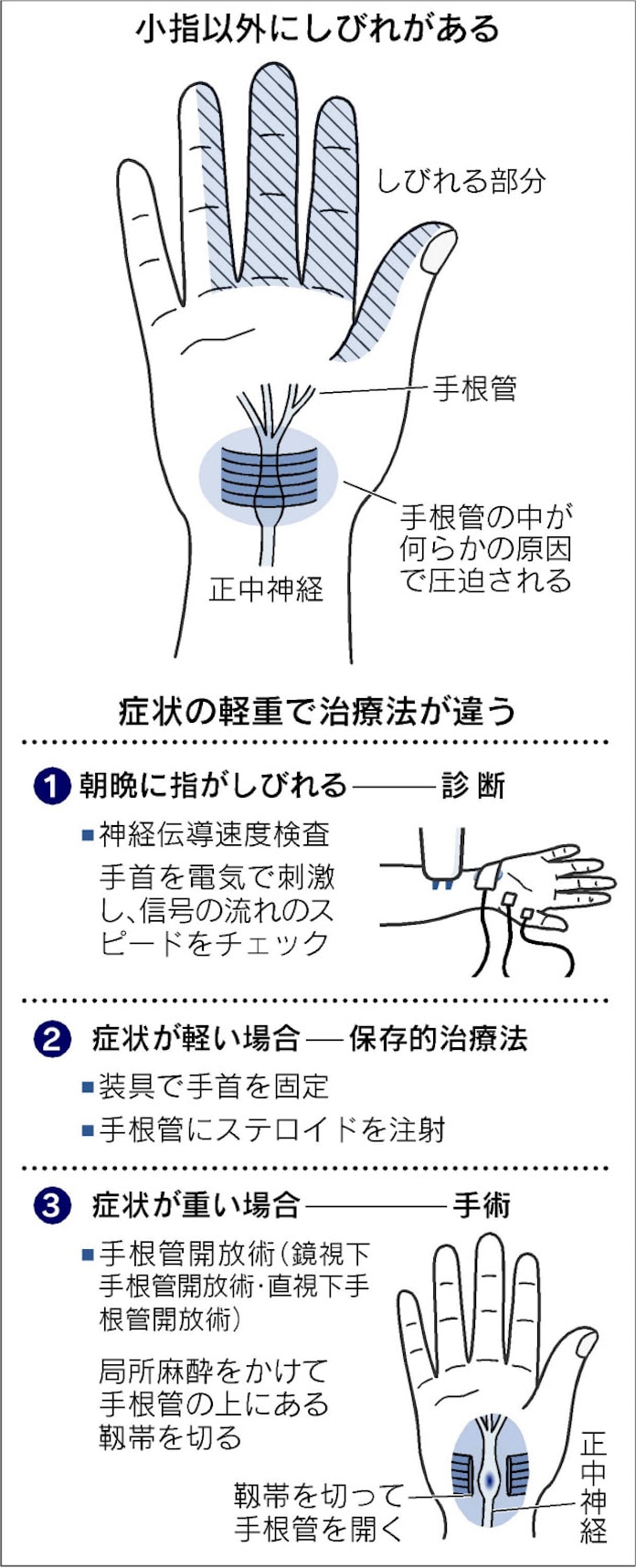 指のしびれ 老化と勘違い怖い 日本経済新聞 指のしびれ 老化と勘違い怖い 日本経済新聞