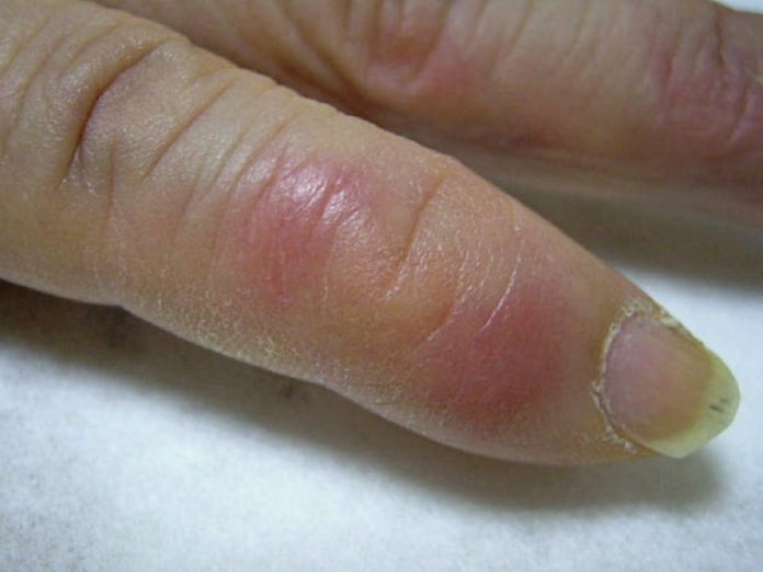 しもやけ 寒暖差大きい春先にご用心 日本経済新聞 しもやけ 寒暖差大きい春先にご用心 日本経済新聞