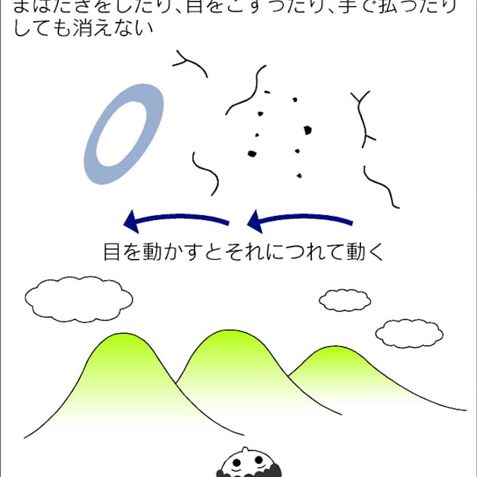 飛蚊症 網膜に傷なら治療 日本経済新聞 飛蚊症 網膜に傷なら治療 日本経済新聞