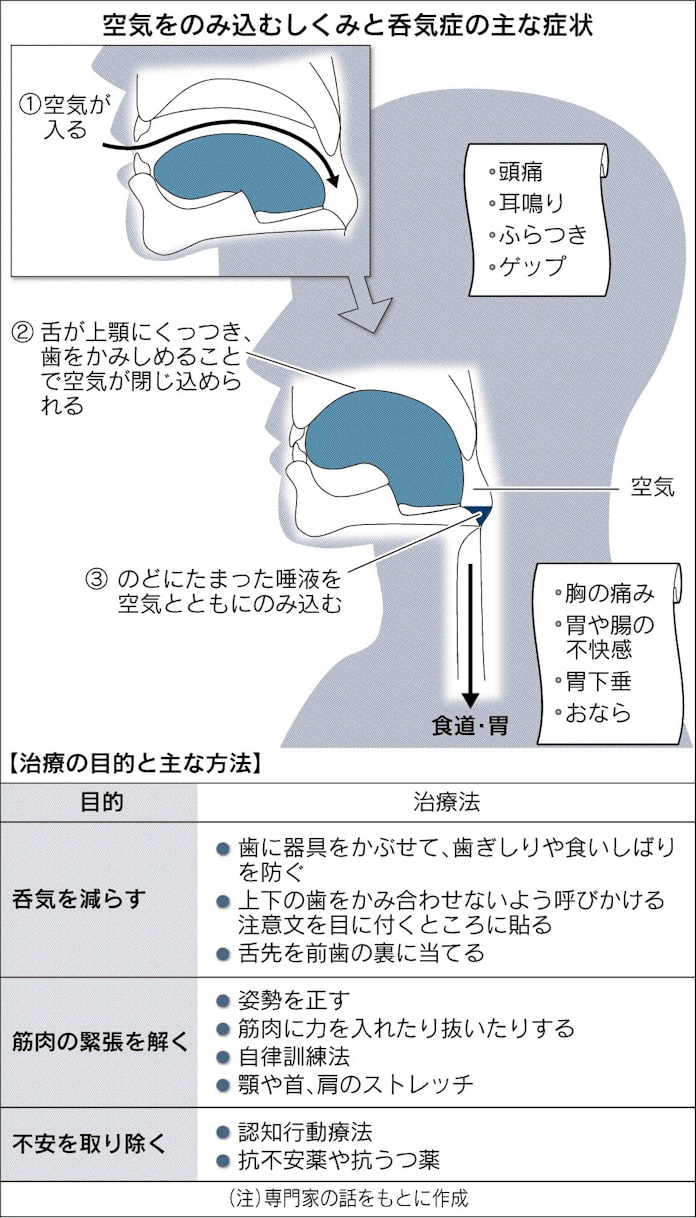 空気を過剰にのみ込む呑気症 日本経済新聞