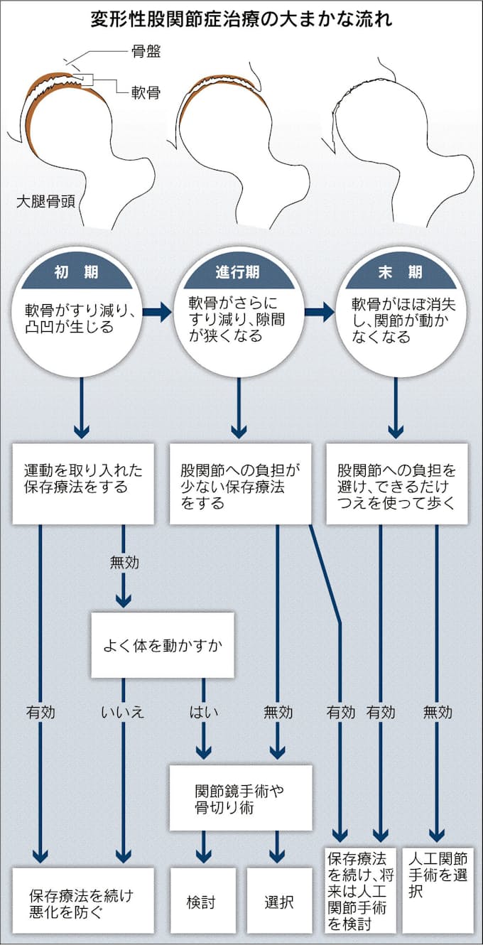 股関節痛っ まず減量を 日本経済新聞 股関節痛っ まず減量を 日本経済新聞